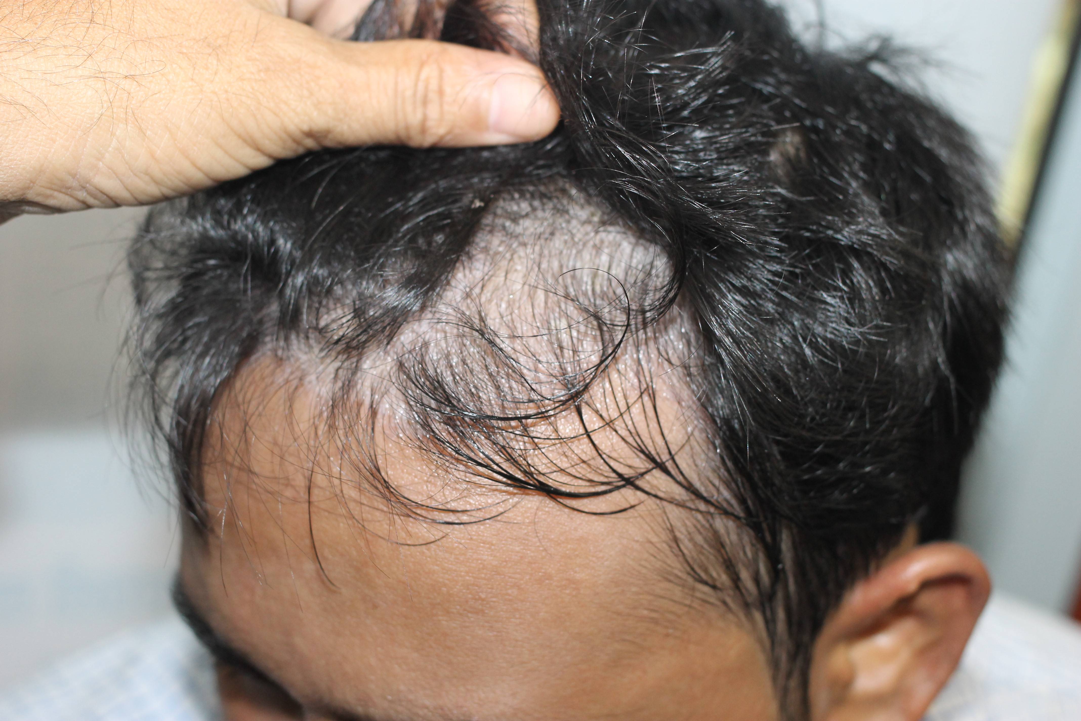 Seborrheic Dermatitis: Ayurvedic Insights & Effective Treatments by VHCA Hair Clinic