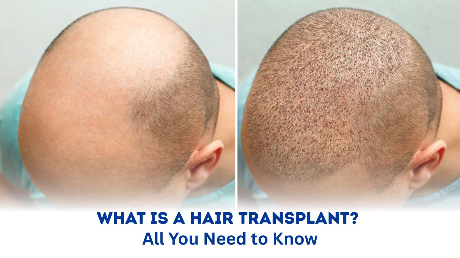 What Is a Hair Transplant? All You Need to Know