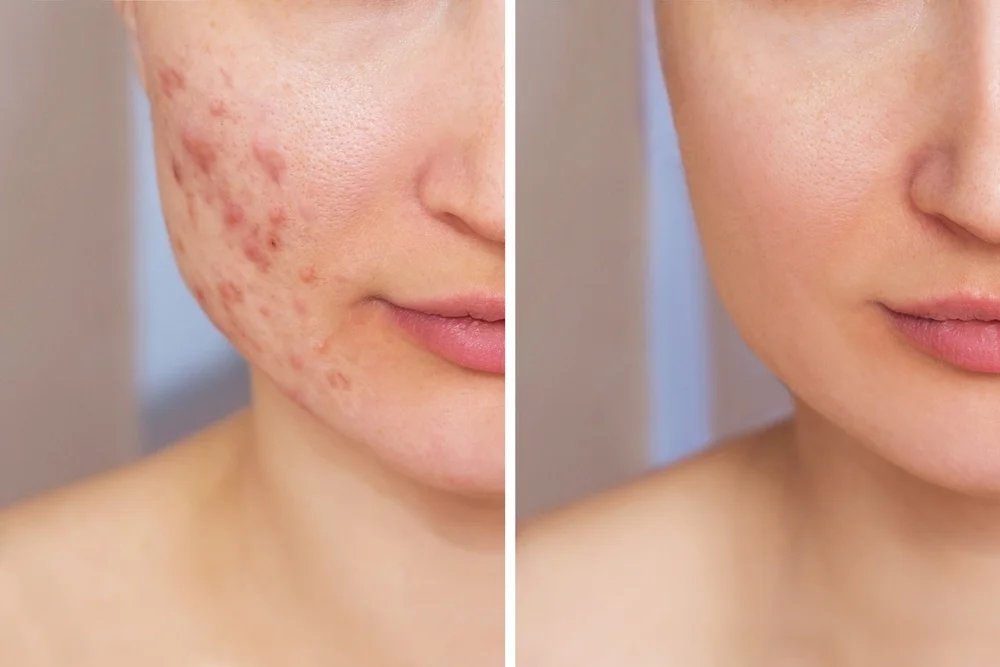 Clear Your Skin with Ayurveda: Causes, Symptoms & Natural Treatment for Acne