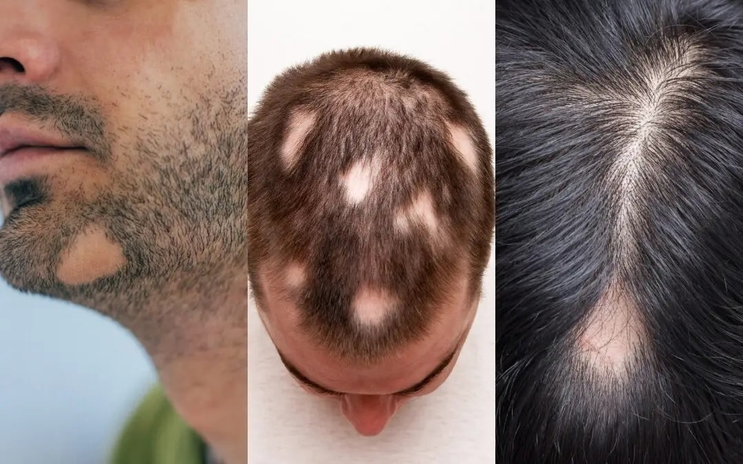 Alopecia Areata