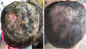 Scalp Fungal Infection: Causes, Symptoms, and Ayurvedic Treatment